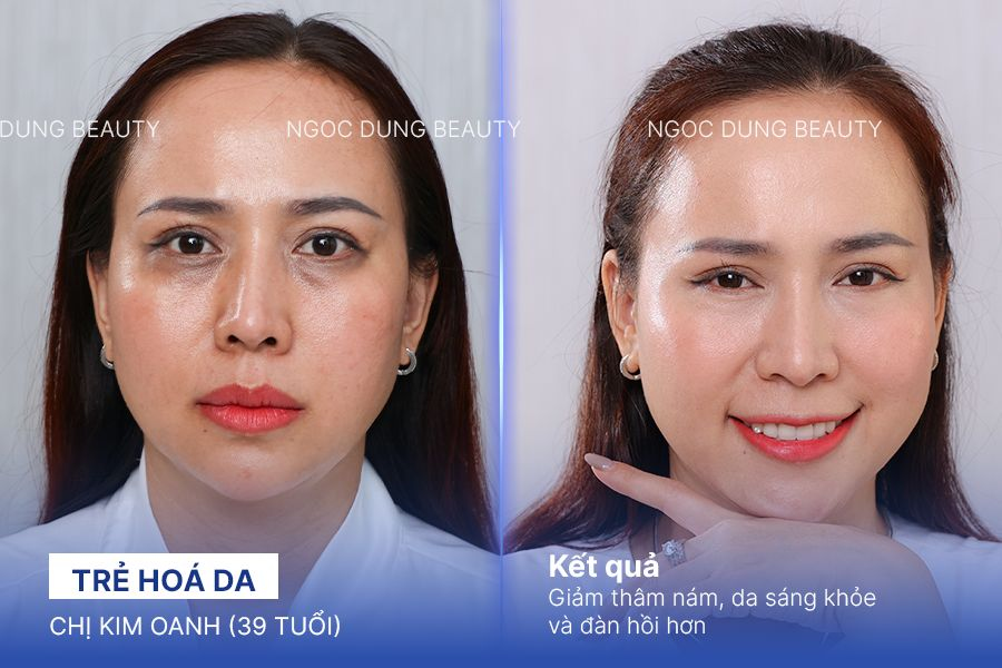 Chi Kim Oanh (39 tuổi) - Trẻ Hoá Da