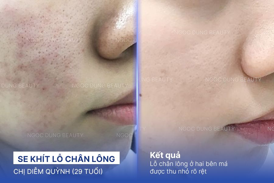 Se khít lỗ chân lông – 8 Buổi – Da sạch mịn kiềm dầu