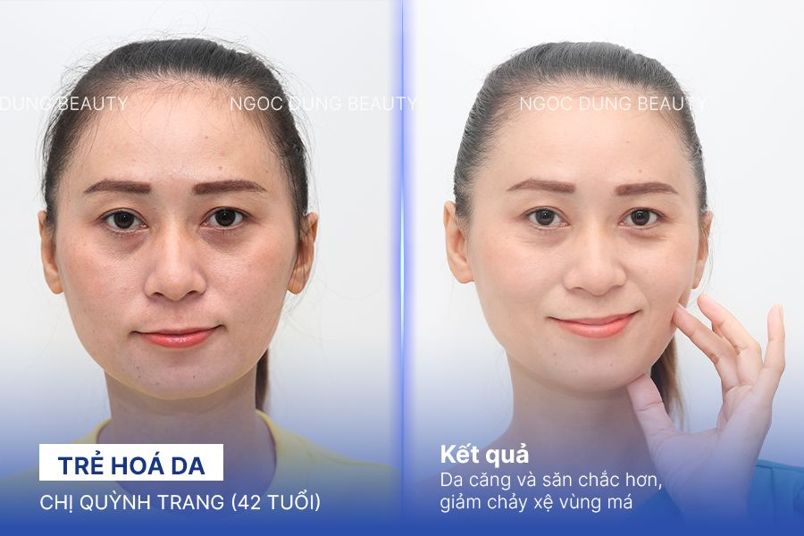 Chị Quỳnh Trang (42 tuổi) - Trẻ Hoá Da