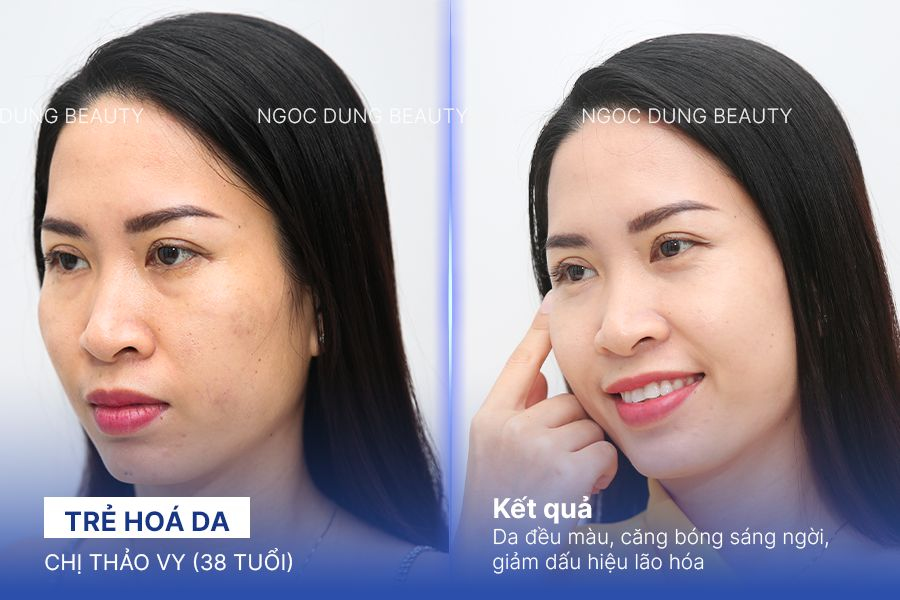 Chị Thảo Vy (38 tuổi) - Trẻ Hoá Da