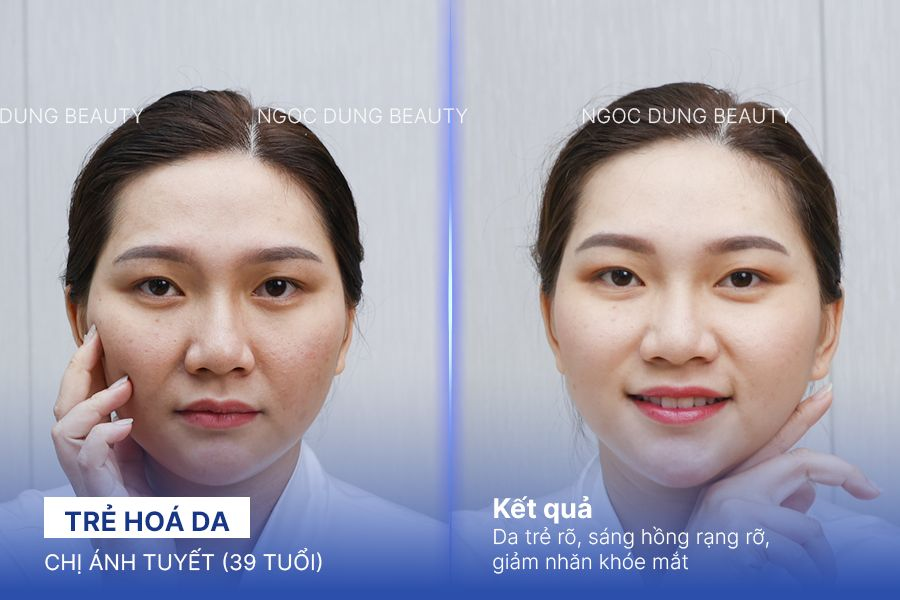 Chị Ánh Tuyết (39 tuổi) - Trẻ Hoá Da