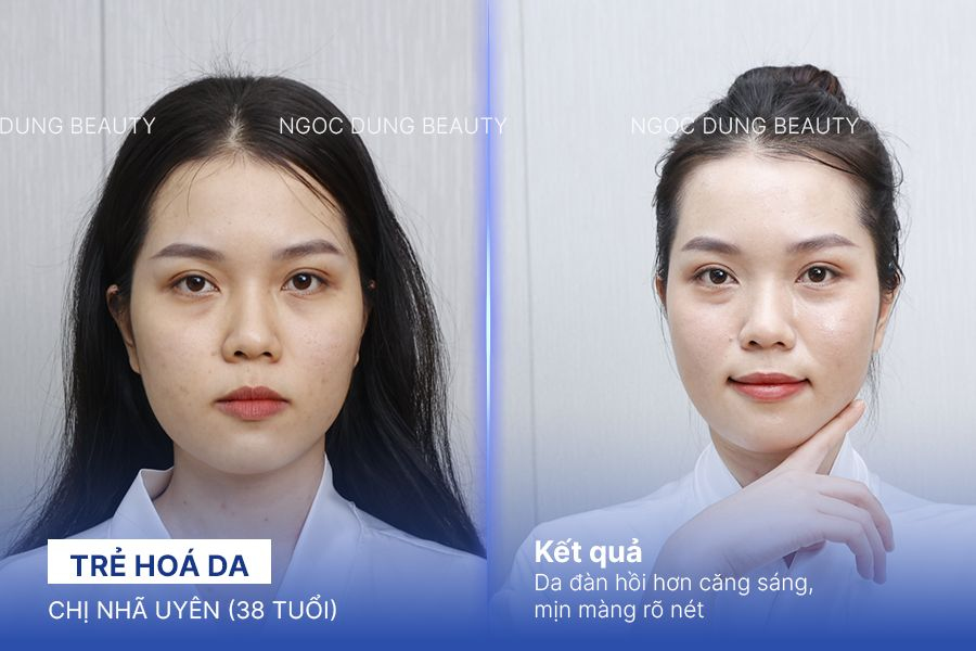 Trẻ hóa da – 7 buổi – Da giảm nám đều màu