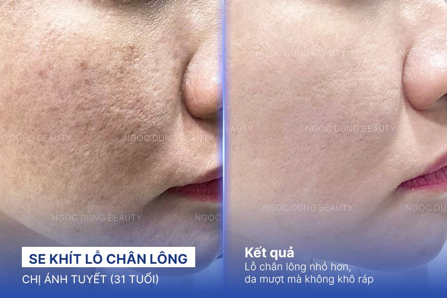 Se khít lỗ chân lông – 6 Buổi – Da mượt mà sạch mịn