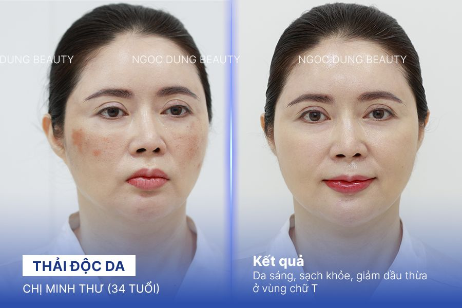 Chị Minh Thư (34 tuổi) - Thải Độc Da