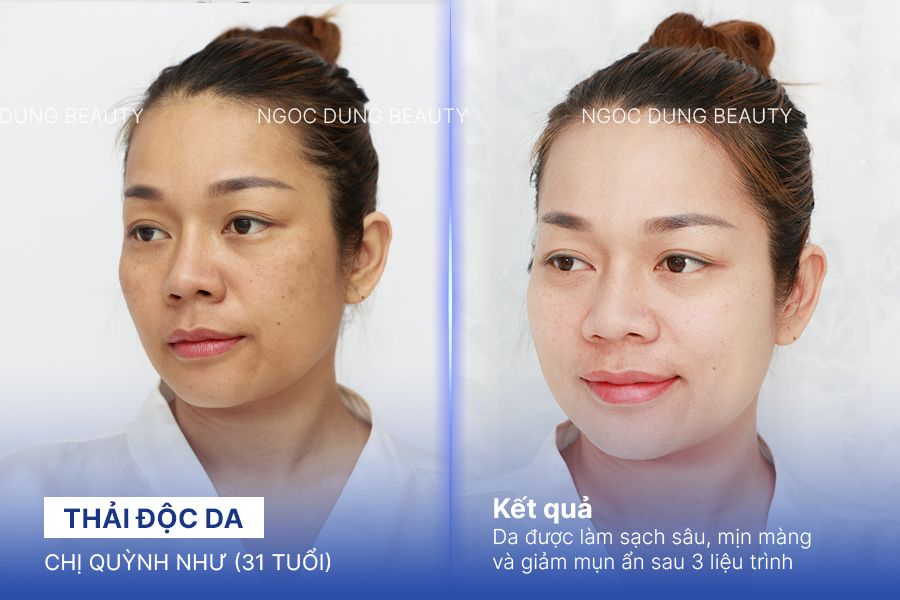 Chị Quỳnh Như (31 tuổi) - Thải Độc Da
