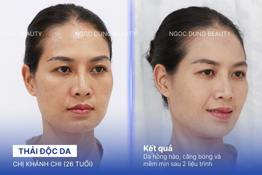 Chị Khánh Chi (26 tuổi) - Thải Độc Da