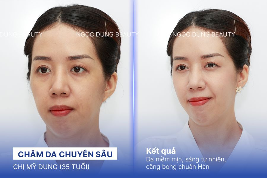 Chăm da chuyên sâu – 8 buổi – Da phục hồi rõ rệt