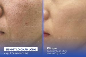 Chị Lê Thắm (28 tuổi) - Se Khít Lỗ Chân Lông