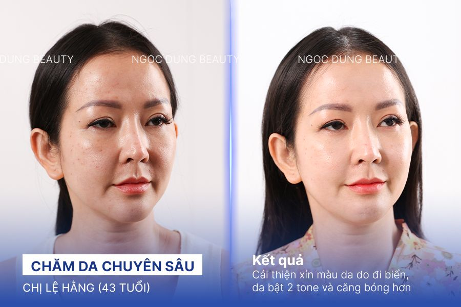 Chăm da chuyên sâu – 4 buổi – Da trắng không tì vết