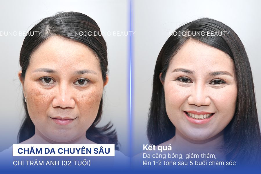 Chị Trâm Anh (32 tuổi) - Chăm Da Chuyên Sâu