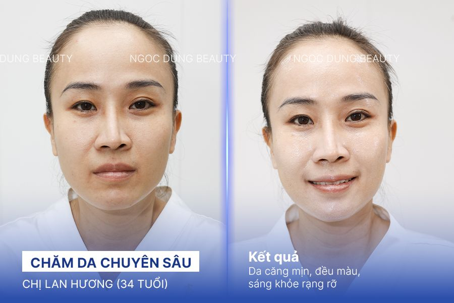 Chị Lan Hương (34 tuổi) - Chăm Da Chuyên Sâu