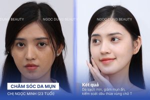Chị Ngọc Minh (23 tuổi) - Chăm Sóc Da Mụn