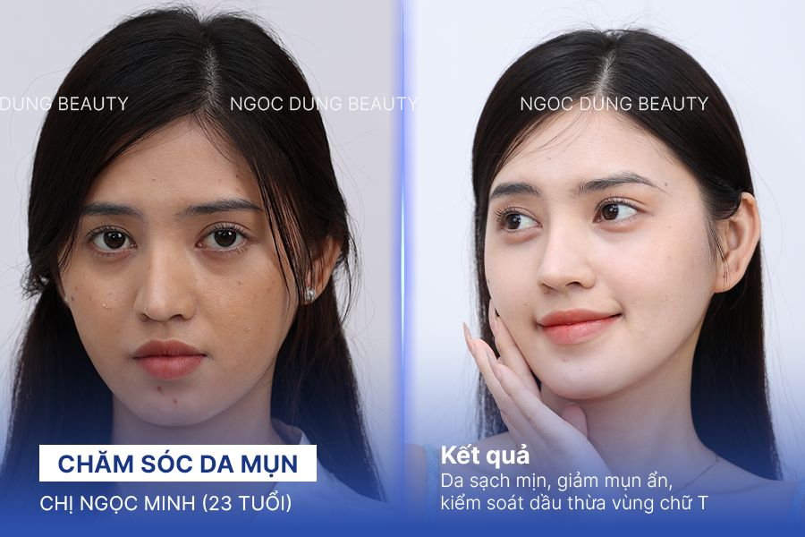 Chăm sóc da mụn – 7 buổi – Kiểm soát dầu hiệu quả