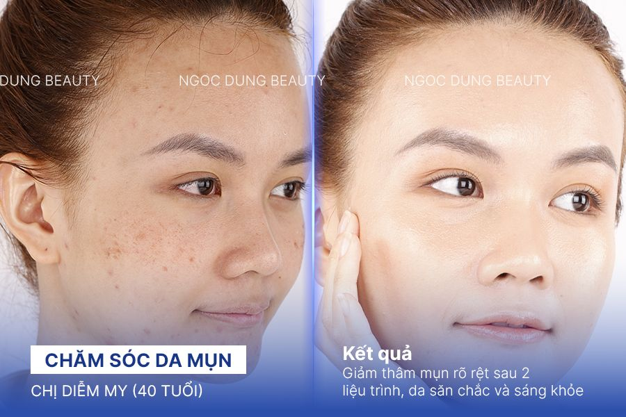 Chăm sóc da mụn – 8 buổi – Sạch mụn và sẹo thâm