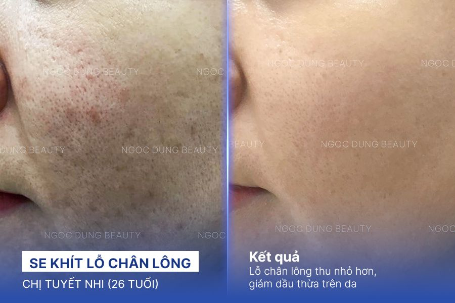 Se khít lỗ chân lông – 5 Buổi – Giảm dầu thừa trên da