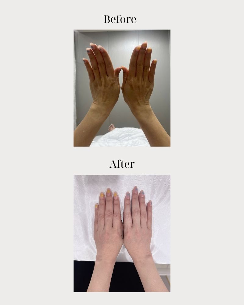 Da tay bật tone sau liệu trình trẻ hóa