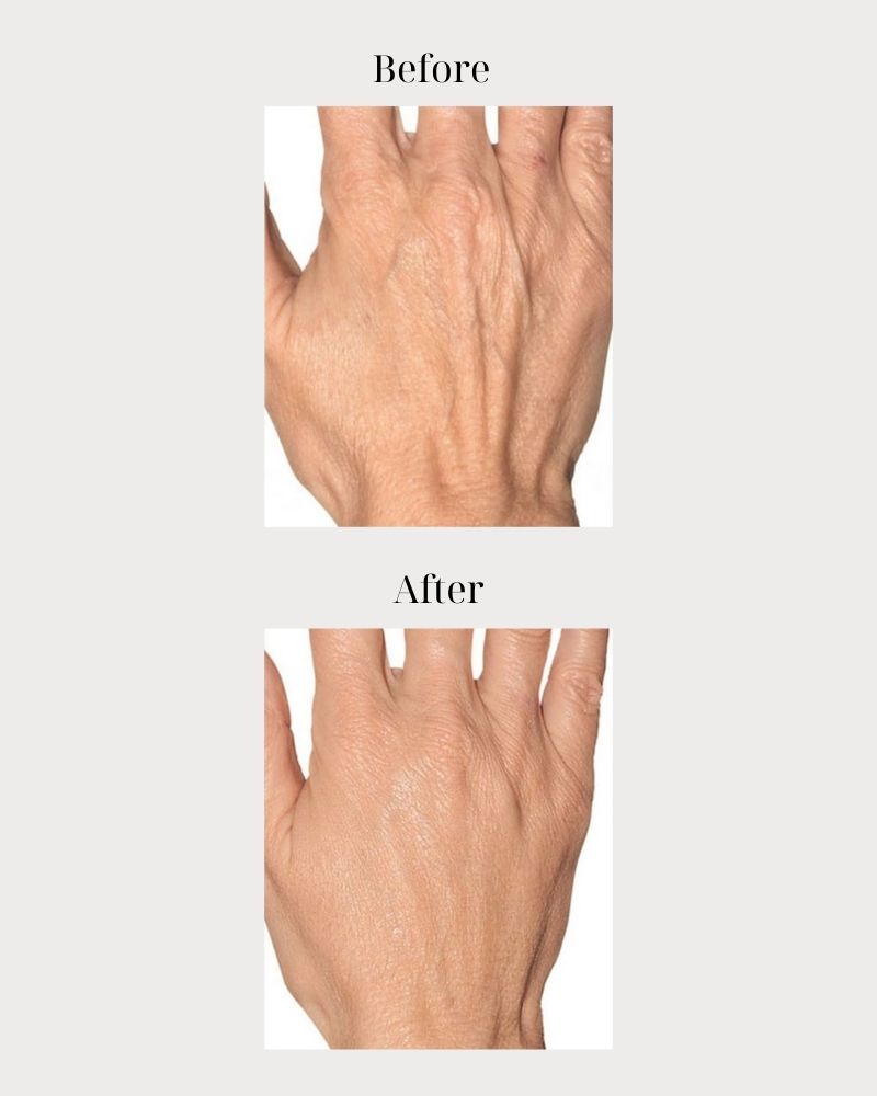 Cải thiện nếp nhăn ở mu bàn tay