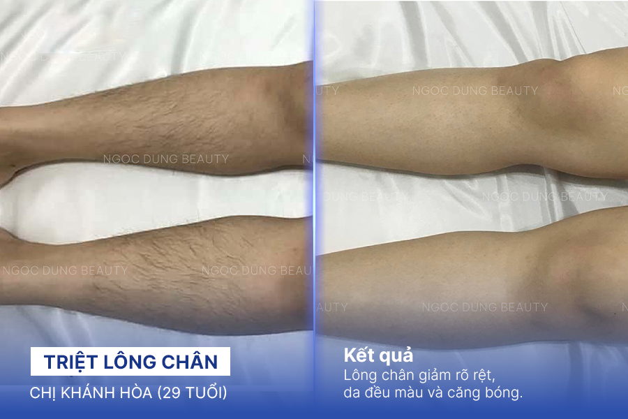Triệt lông chân – 11 buổi – Lông mọc thưa và nhạt hơn