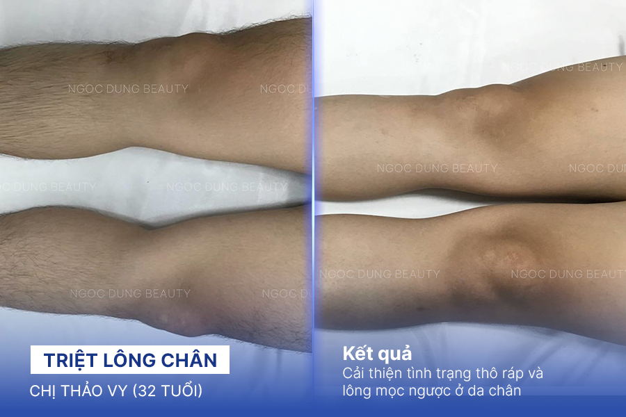 Triệt lông chân – 8 buổi – Giảm tình trạng lông chân mọc ngược