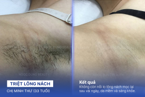 Triệt lông nách – 12 buổi – Nách sạch lông và giảm thâm