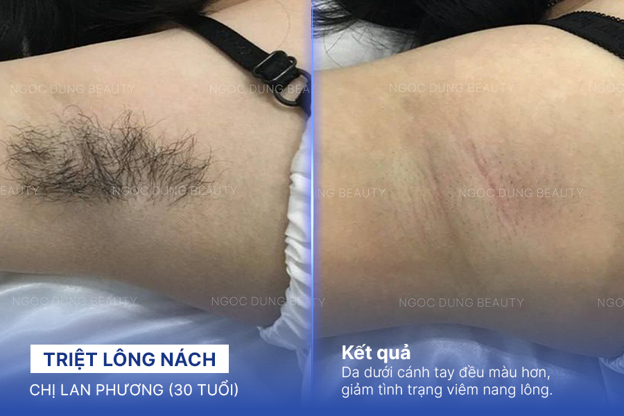 Triệt lông nách – 7 buổi – Nách thông thoáng cả ngày