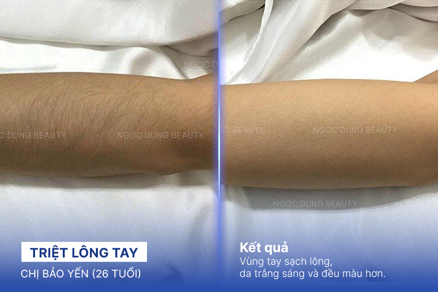 Triệt lông tay – 10 buổi – Tự tin diện áo ngắn tay