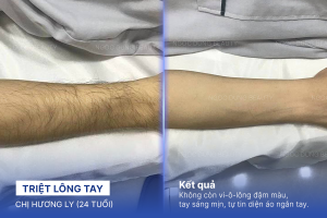 Triệt lông tay – 6 buổi – Lông mảnh và da tay sáng hơn