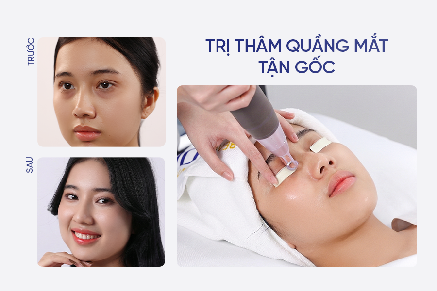 Trị thâm mắt hiệu quả giúp gương mặt tươi sáng và rạng rỡ hơn
